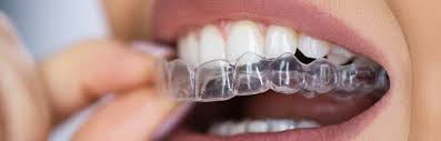 Aligners and Braces - Your Smile Architects 4