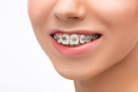Aligners and Braces - Your Smile Architects 3